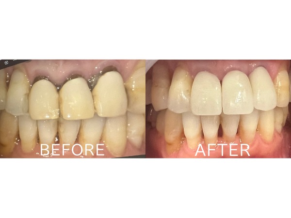 ビフォアーアフター画像｜【症例】抜歯・歯周病治療を経て前歯をジルコニアセラミックで美しく修復した治療｜センター南の歯医者「センター南デンタルクリニック」