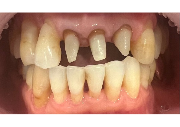 治療中|【症例】抜歯・歯周病治療を経て前歯をジルコニアセラミックで美しく修復した治療|センター南の歯医者「センター南デンタルクリニック」