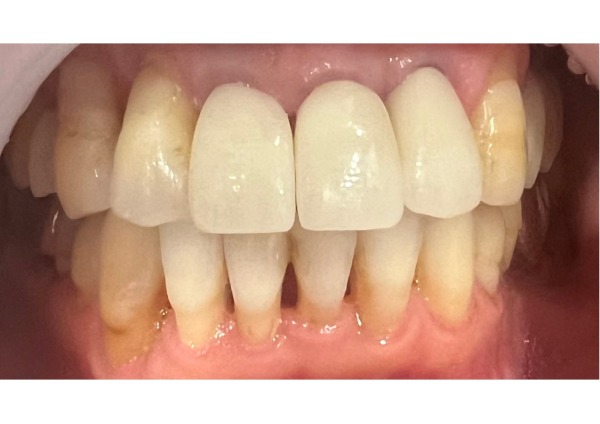 治療後|【症例】抜歯・歯周病治療を経て前歯をジルコニアセラミックで美しく修復した治療|センター南の歯医者「センター南デンタルクリニック」