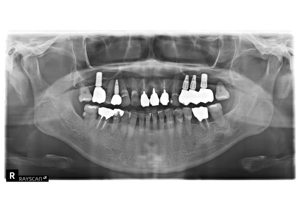 パノラマ画像|【症例】抜歯・歯周病治療を経て前歯をジルコニアセラミックで美しく修復した治療|センター南の歯医者「センター南デンタルクリニック」