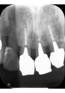 デンタル画像|【症例】抜歯・歯周病治療を経て前歯をジルコニアセラミックで美しく修復した治療|センター南の歯医者「センター南デンタルクリニック」