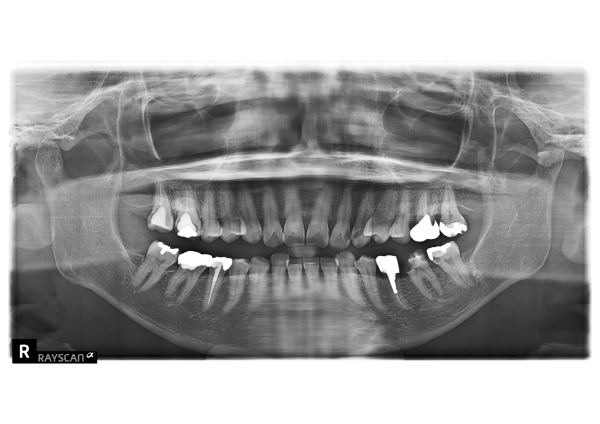 パノラマ画像｜【症例】神経に到達した奥歯と前歯の虫歯を異なる材料で修復した治療｜センター南の歯医者「センター南デンタルクリニック」