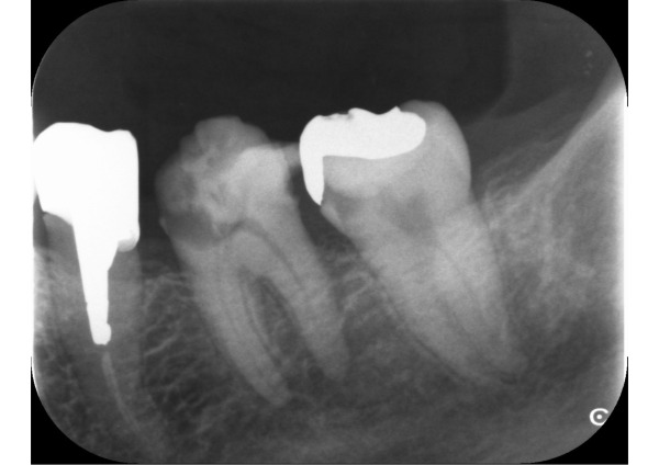 奥歯の治療前のデンタル画像｜【症例】神経に到達した奥歯と前歯の虫歯を異なる材料で修復した治療｜センター南の歯医者「センター南デンタルクリニック」