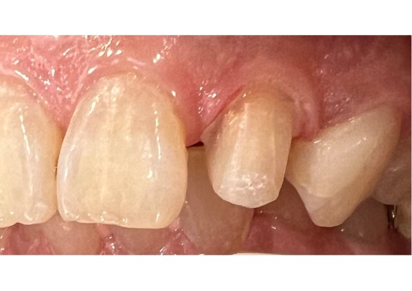 前歯の形成後の写真｜【症例】神経に到達した奥歯と前歯の虫歯を異なる材料で修復した治療｜センター南の歯医者「センター南デンタルクリニック」