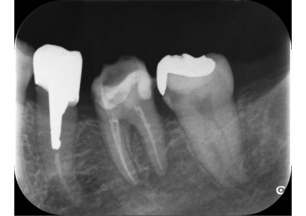 奥歯の根管充填後のデンタル｜【症例】神経に到達した奥歯と前歯の虫歯を異なる材料で修復した治療｜センター南の歯医者「センター南デンタルクリニック」