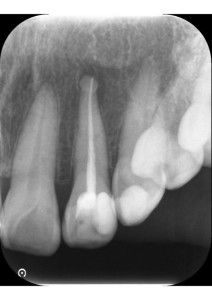 前歯の根管充填後のデンタル｜【症例】神経に到達した奥歯と前歯の虫歯を異なる材料で修復した治療｜センター南の歯医者「センター南デンタルクリニック」