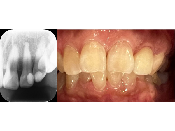 プラスチック修復後のデンタルと被せ物装着後｜【症例】神経に到達した奥歯と前歯の虫歯を異なる材料で修復した治療｜センター南の歯医者「センター南デンタルクリニック」