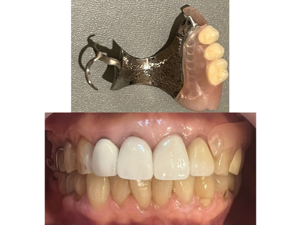 チタンを使用した金属床の入れ歯と装着写真｜【症例】差し歯が２回外れて、金属床で咬み合わせを回復した治療｜センター南の歯医者「センター南デンタルクリニック」