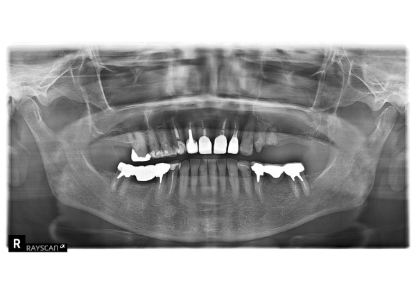 パノラマ画像｜【症例】差し歯が２回外れて、金属床で咬み合わせを回復した治療｜センター南の歯医者「センター南デンタルクリニック」
