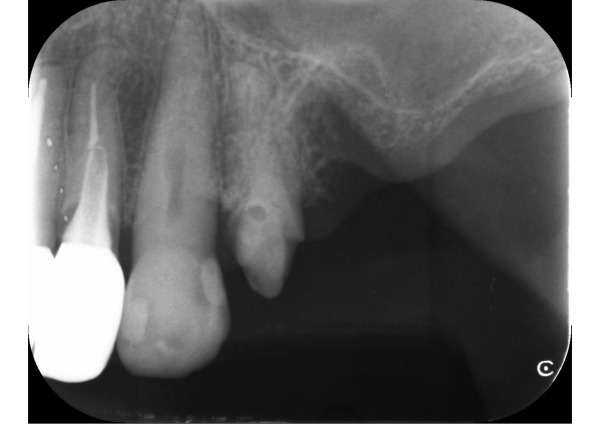 デンタル画像｜【症例】差し歯が２回外れて、金属床で咬み合わせを回復した治療｜センター南の歯医者「センター南デンタルクリニック」