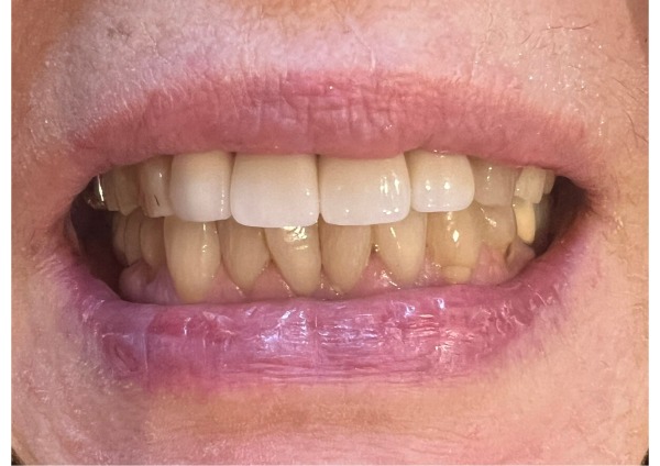 入れ歯装着後にお口を開けたときの写真｜【症例】差し歯が２回外れて、金属床で咬み合わせを回復した治療｜センター南の歯医者「センター南デンタルクリニック」