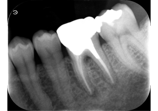 初診時のデンタル|【症例】破折した歯を抜歯し、インプラントで咬み合わせを回復した治療|センター南の歯医者「センター南デンタルクリニック」