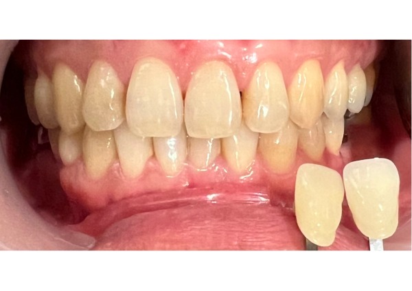 型取り前の写真|【症例】破折した歯を抜歯し、インプラントで咬み合わせを回復した治療|センター南の歯医者「センター南デンタルクリニック」