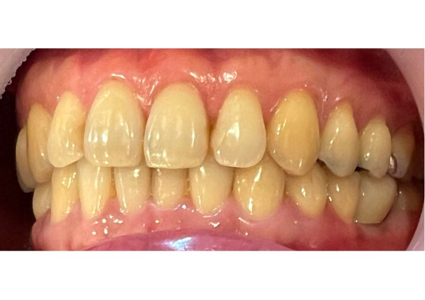 インプラント上部セット後の写真|【症例】破折した歯を抜歯し、インプラントで咬み合わせを回復した治療|センター南の歯医者「センター南デンタルクリニック」