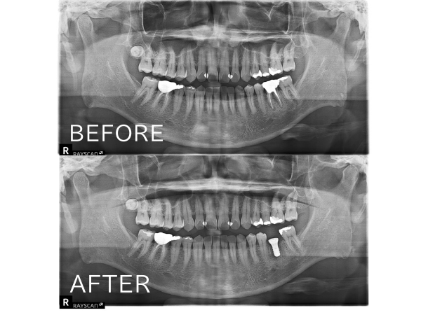 ビフォアーアフター画像| 【症例】破折した歯を抜歯し、インプラントで咬み合わせを回復した治療｜センター南の歯医者「センター南デンタルクリニック」