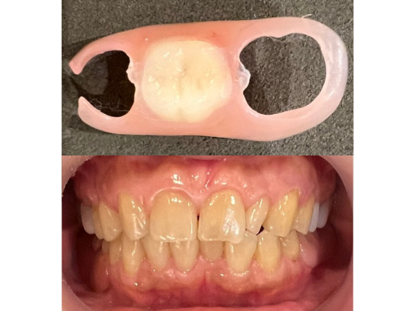 After画像｜【症例】金属アレルギーの患者様をノンクラスプデンチャーで修復した治療｜センター南の歯医者「センター南デンタルクリニック」