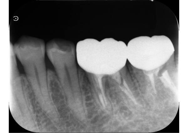 根管治療前のデンタル｜【症例】金属アレルギーの患者様をノンクラスプデンチャーで修復した治療｜センター南の歯医者「センター南デンタルクリニック」