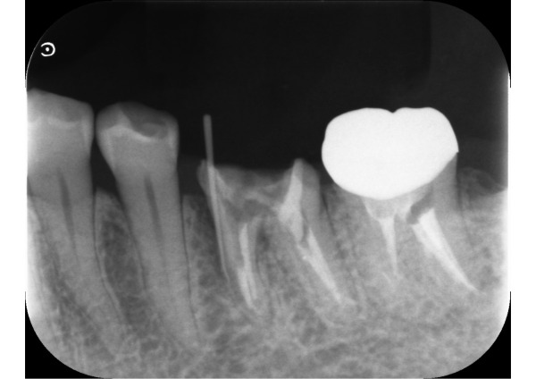 造影性のゴムを入れたデンタル　｜【症例】金属アレルギーの患者様をノンクラスプデンチャーで修復した治療｜センター南の歯医者「センター南デンタルクリニック」