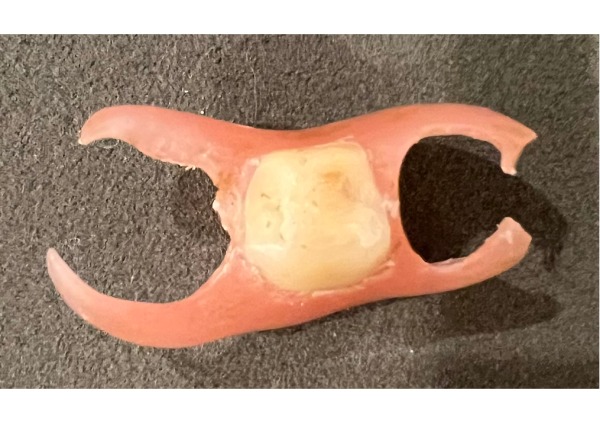 右下のノンクラスプデンチャー｜【症例】金属アレルギーの患者様をノンクラスプデンチャーで修復した治療｜センター南の歯医者「センター南デンタルクリニック」