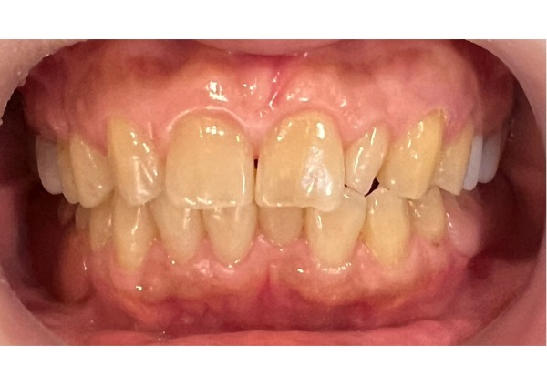 口腔内に装着した正面観写真｜【症例】金属アレルギーの患者様をノンクラスプデンチャーで修復した治療｜センター南の歯医者「センター南デンタルクリニック」