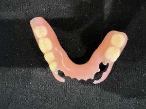 ノンクラスプデンチャー｜【症例】奥歯がなく噛めない咬合を、ノンクラスプデンチャーで改善｜センター南の歯医者「センター南デンタルクリニック」