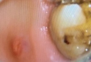 左上6　口腔内写真（サイナストラクト）｜【症例】CT診断および根管治療によって抜歯を免れた歯のセラミック修復治療｜センター南の歯医者「センター南デンタルクリニック」
