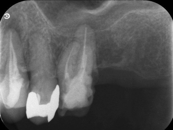 左上6　根充後の口腔内Ｘ線写真｜【症例】CT診断および根管治療によって抜歯を免れた歯のセラミック修復治療｜センター南の歯医者「センター南デンタルクリニック」