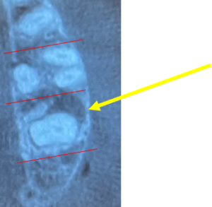 CT 左上7｜【症例】CT診断および根管治療によって抜歯を免れた歯のセラミック修復治療｜センター南の歯医者「センター南デンタルクリニック」