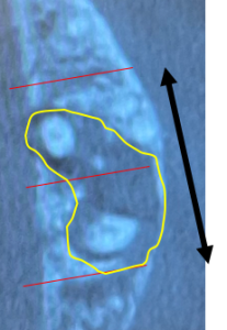 CT　左上6｜【症例】CT診断および根管治療によって抜歯を免れた歯のセラミック修復治療｜センター南の歯医者「センター南デンタルクリニック」