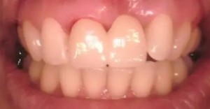 ジルコニアセラミック装着後の写真|【症例】10年間使用した仮歯をジルコニアセラミックにした治療| センター南の歯医者「センター南デンタルクリニック」