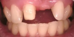 型取り前の写真|【症例】10年間使用した仮歯をジルコニアセラミックにした治療| センター南の歯医者「センター南デンタルクリニック」