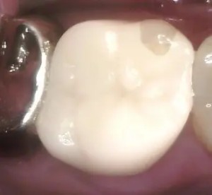 ジルコニアセット後の写真｜【症例】突然かけた奥歯をジルコニアで修復した治療｜ センター南の歯医者「センター南デンタルクリニック」