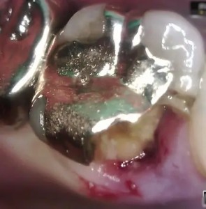 破折片を除去した写真｜【症例】突然かけた奥歯をジルコニアで修復した治療｜ センター南の歯医者「センター南デンタルクリニック」
