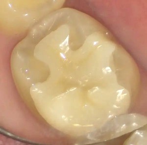 ジルコニアアンレーセット後の写真|【症例】歯髄に達する虫歯がある小臼歯をセラミックで、詰め物が取れた大臼歯をジルコニアで修復した治療| センター南の歯医者「センター南デンタルクリニック」