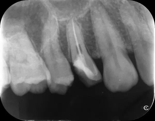 根充後のデンタル|【症例】歯髄に達する虫歯がある小臼歯をセラミックで、詰め物が取れた大臼歯をジルコニアで修復した治療| センター南の歯医者「センター南デンタルクリニック」
